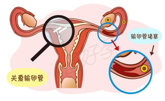 宫寒输卵管堵塞可以汗蒸吗