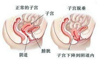 直肠粘膜脱垂怎么办。