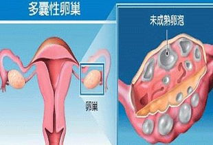 青春期少女多囊卵巢综合症能治愈吗