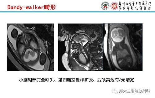 胎儿头颅核磁共振什么时候检查最好呢