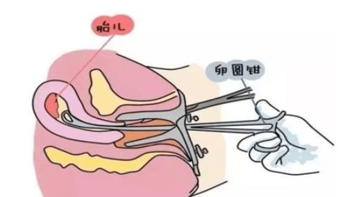 女性做人工授精前的准备可以同房吗