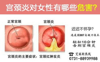 宫颈炎的危害有哪些呢