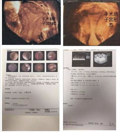 我想知道怀孕多久子宫才会有妊娠囊回声？