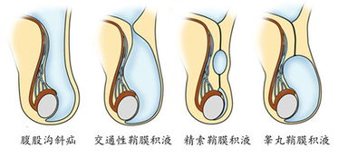 睾丸积液不治疗有什么影响