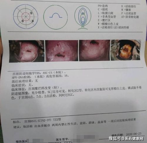 女性hpv和tct检查多少钱