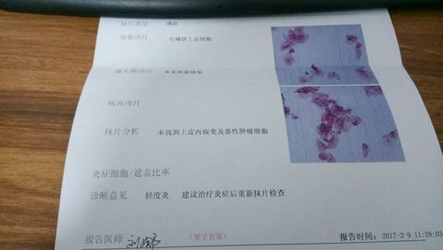 女性hpv和tct检查多少钱