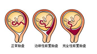 胎盘位于前壁后壁有什么影响