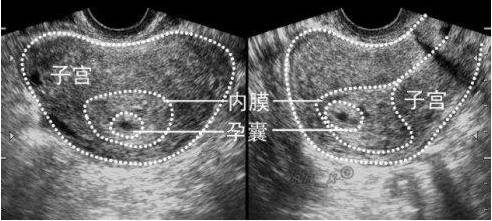 孕囊圆形一定是女孩吗?