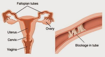 人流后如何预防输卵管堵塞