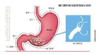 幽门螺旋杆菌要吃多久药才会好