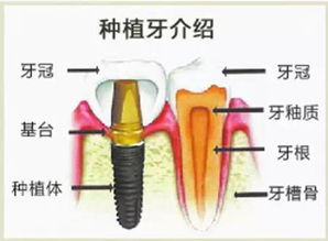 种植牙需要多长的时间才能做好？