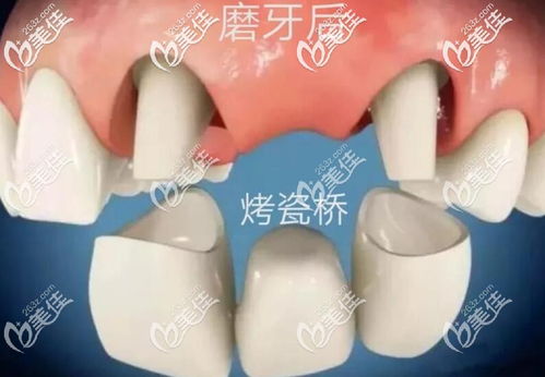 怎么把嘴里固定的假牙弄下来啊