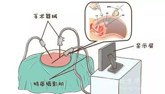 输卵管造影 费用