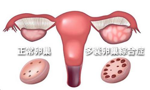 如何正确认识多囊卵巢综合征