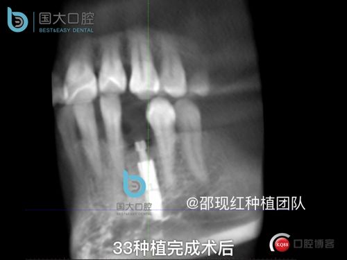 牙槽骨种植属于什么手术