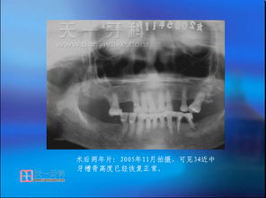 牙槽骨种植属于什么手术