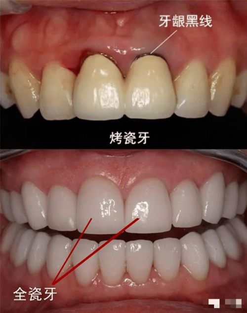 应该装全瓷牙还是烤瓷牙？