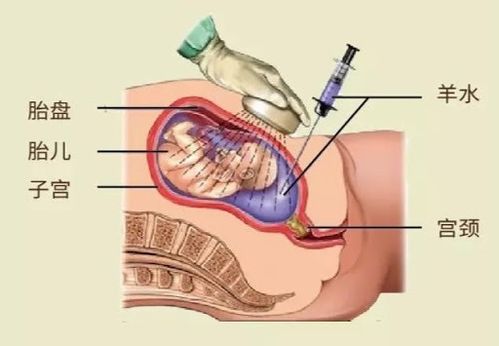 怀孕7周宫腔积血对胎儿有影响吗