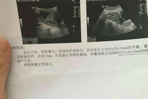 为什么b超检查男孩比女孩的准确率高