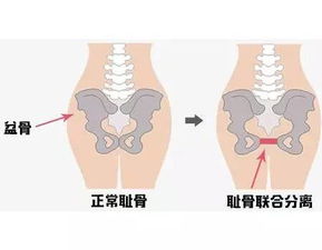 孕晚期耻骨痛是怎么回事