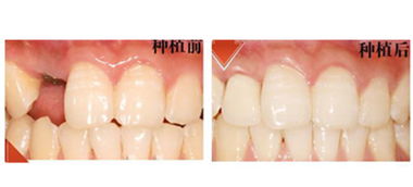 种植牙多少钱一颗