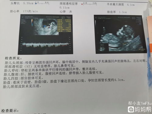 nt是否比糖筛准确