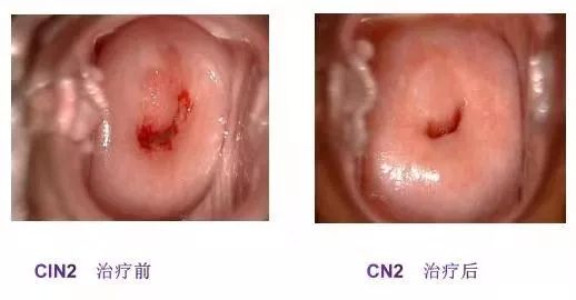 做hpv检查后要禁忌什么