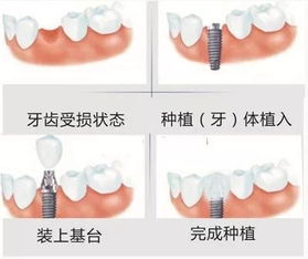 牙齿缺失装什么样的假牙比较好