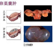 黄体囊肿破裂可以抽烟吗