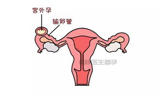 备孕期间怎样防止宫外孕