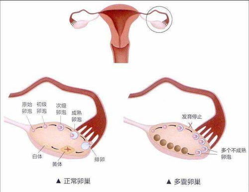 卵巢储备功能下降容易怀孕吗