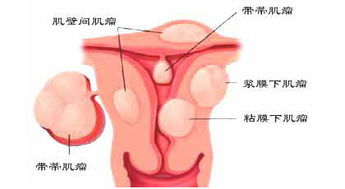 卵巢良性恶性肿瘤如何鉴别