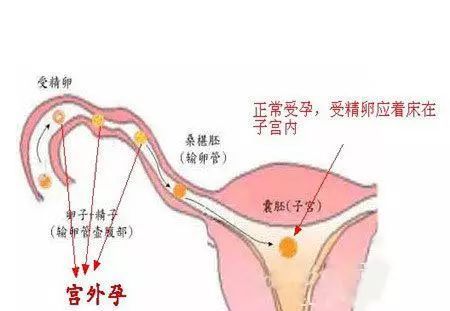 宫外孕腹腔镜手术后多久同房最好