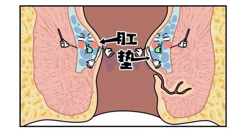 孕妇肛裂该如何调理治疗好