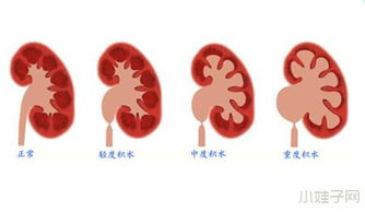 胎儿有肾积水是什么原因造成的