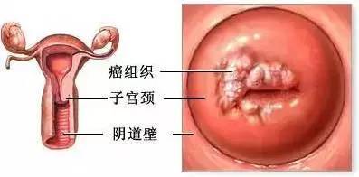 孕妇宫颈息肉手术危害大吗