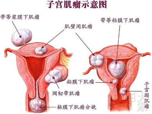 小儿睾丸胎畸瘤是恶性肿瘤吗