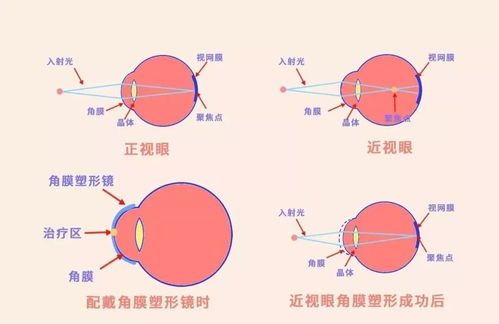 艾灸对近视有效吗视频