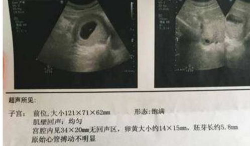 怀孕15周孕囊大小图片