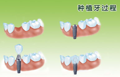 活动义齿晚上睡覚戴好还是不戴好？