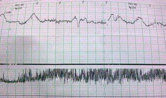 有没有怀男孩胎心率高150次以上的