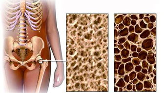 男士骨质疏松的原因有哪些