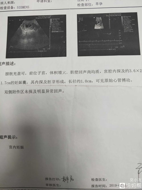 烟台毓璜顶医院做四维需要提前预约吗要准备什么