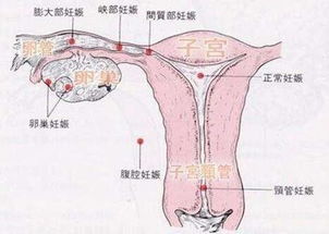 阴超能检查出宫外孕吗?