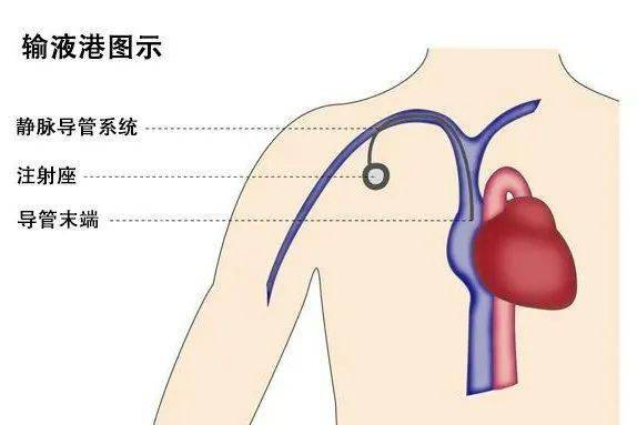 精索静脉曲张！彩超说，CDfL:valsalva试验静脉内可见反向血流信号，这句