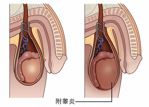 附睾炎会引起无精症吗