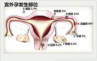 宫外孕初期可用中药治疗吗