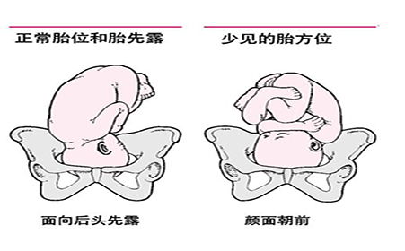 胎位不正怎么纠正图