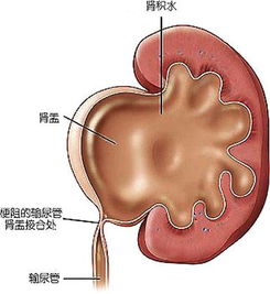 肾盂分离的后果是什么?