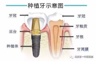 现安装固定牙好还是活动牙好